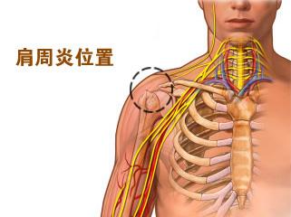 武汉快速xx肩周炎 专业 安全 {sx}郑昌才大夫