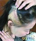 石家莊腦系醫(yī)院脫發(fā)zl中心教你如何在生活中防zt發(fā)