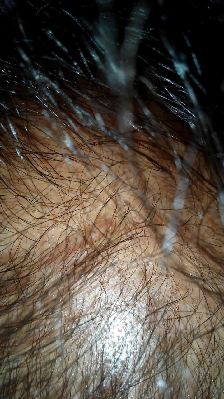 石家莊腦系醫院—zl脫發白發的{tx}療法