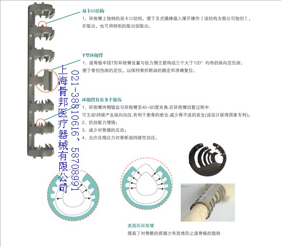 記憶合金環抱器zl人工髖關節置換術后股骨假體周圍骨折原始圖片2