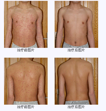 zl荨麻疹的{tx}药 刀郎清zy了我6年的荨麻疹