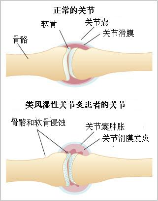 武昌zl类风湿性关节炎 快速zl 效果好 【郑昌才】