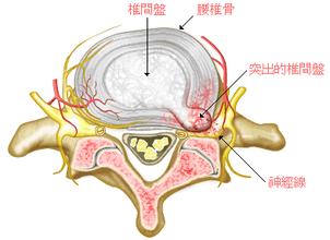 武漢小針刀腰椎間盤突出 價格優(yōu)惠 專業(yè)安全 鄭昌才