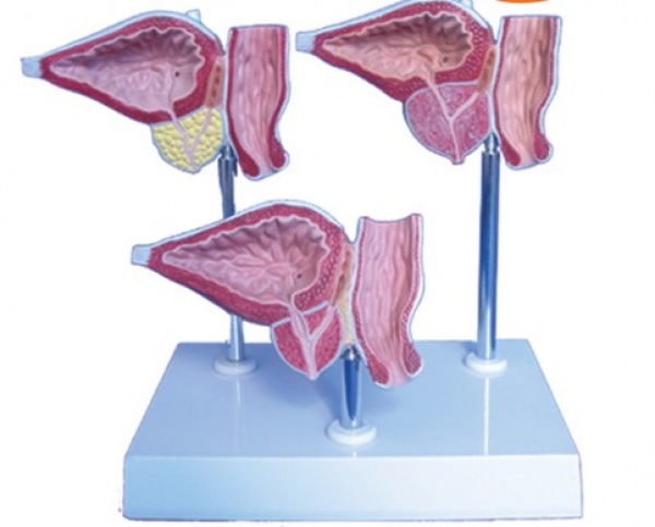 KAY-A755前列腺病态模型-前列腺病变演示模型-泌尿生殖内分泌系统-上海康谊医学模型厂家