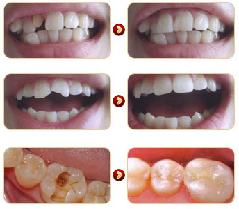 黃岡牙齒修復(fù)費(fèi)用-黃岡皓雅口腔醫(yī)院